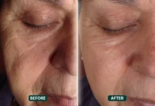 Facelift in Dubai
